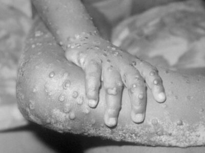 103585163 monkeypox getty здоровье здоровье