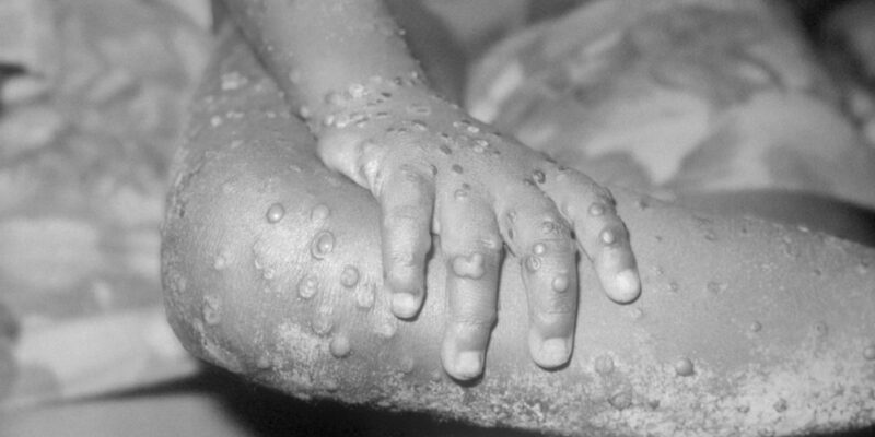 103585163 monkeypox getty Новости BBC здоровье