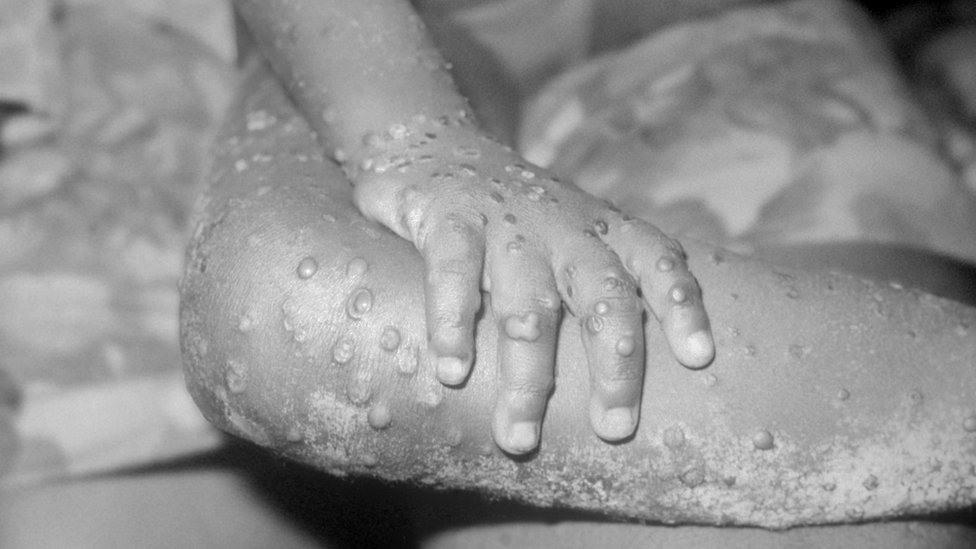 103585163 monkeypox getty Новости BBC здоровье