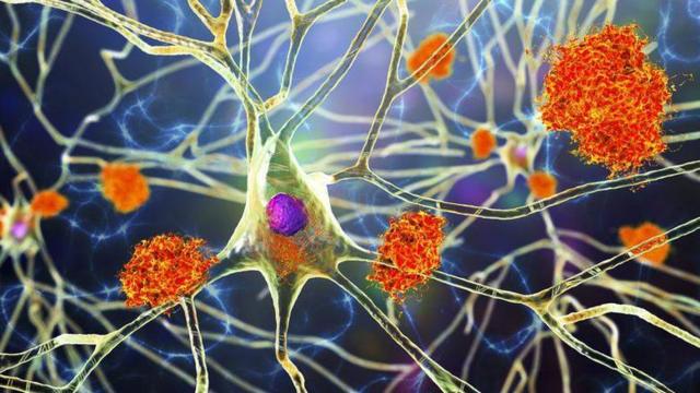 dce55410 f2a0 11ee a684 e7baed526fa8 BBC News Русская служба Великобритания, деменция